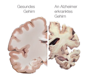 Alzheimer | SchulLV