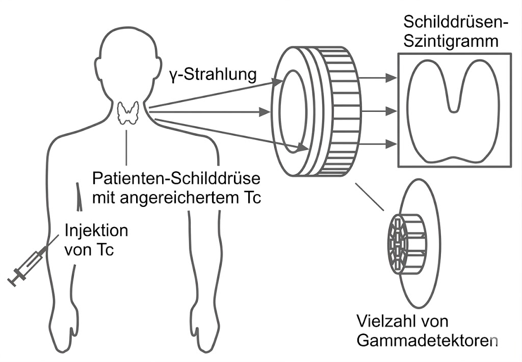 Schematische Darstellung einer Schilddrüsen-Szintigraphie: Injektion von Tc, Strahlung und Gammadetektoren erzeugen Szintigramm.