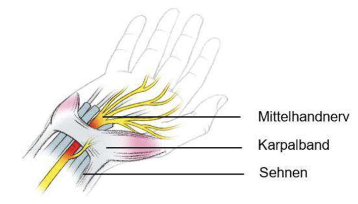 Schematische Darstellung eines Handgelenks mit Mittelhandnerv, Karpalband und Sehnen