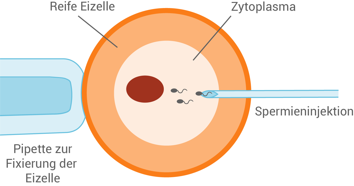 Intracystoplasmatische Spermieninjektion