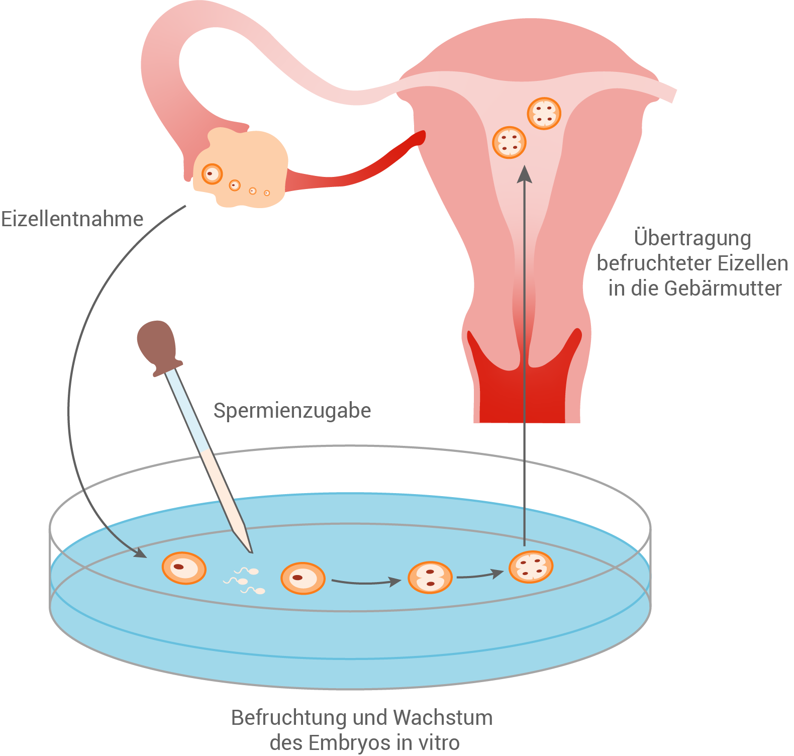 in vitro fertilisation